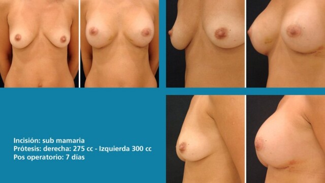 protesis27-1-8321530