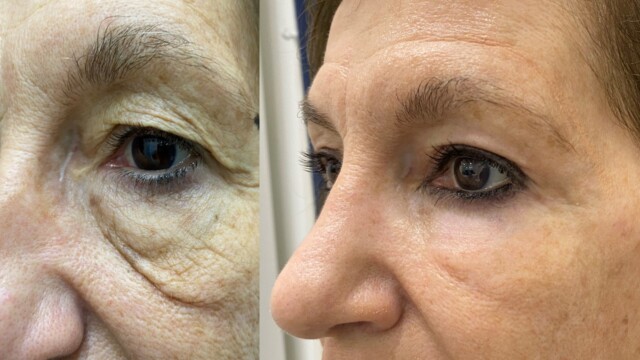 Blépharoplastie-paupières-chirurgie au laser