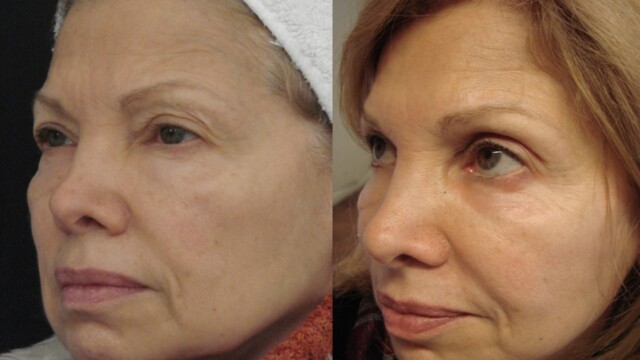 Blépharoplastie-paupières-chirurgie au laser