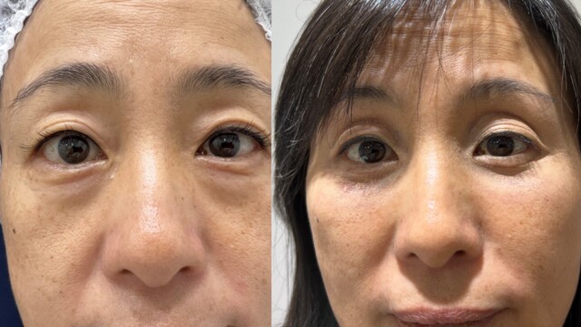 Blépharoplastie-paupières-chirurgie au laser