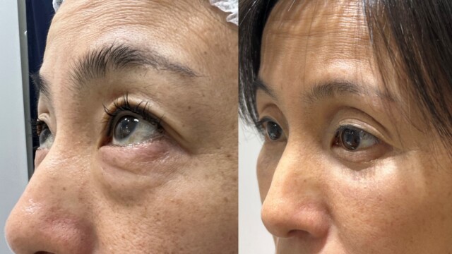 Blépharoplastie-paupières-chirurgie au laser