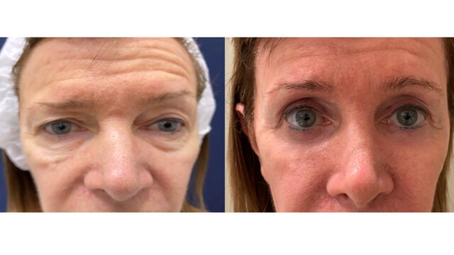 Blépharoplastie-paupières-chirurgie-laser-9225859