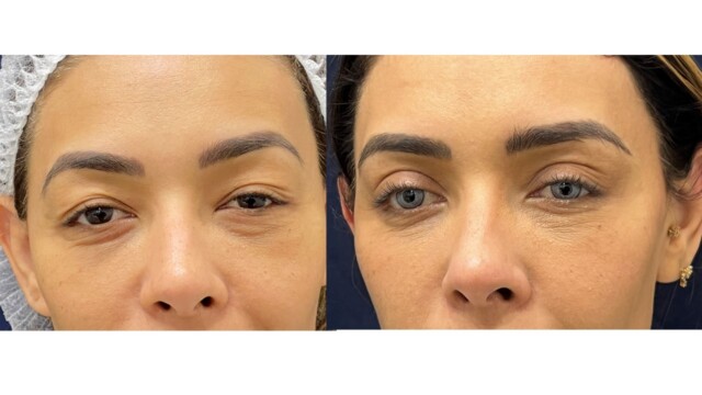 Blépharoplastie-paupières-chirurgie au laser