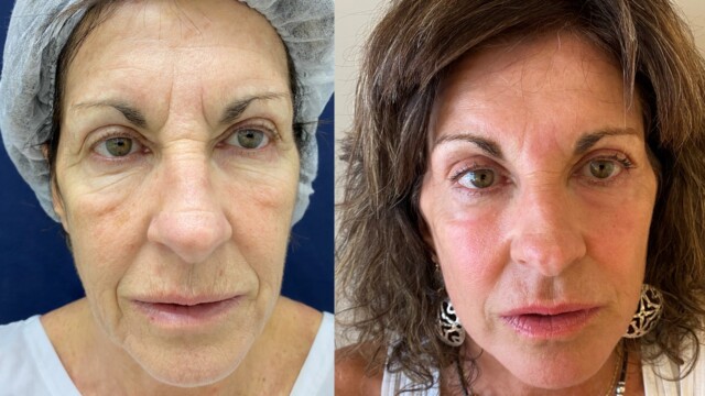 Blépharoplastie-paupières-chirurgie au laser