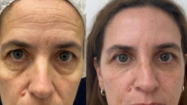Blépharoplastie-paupières-chirurgie au laser