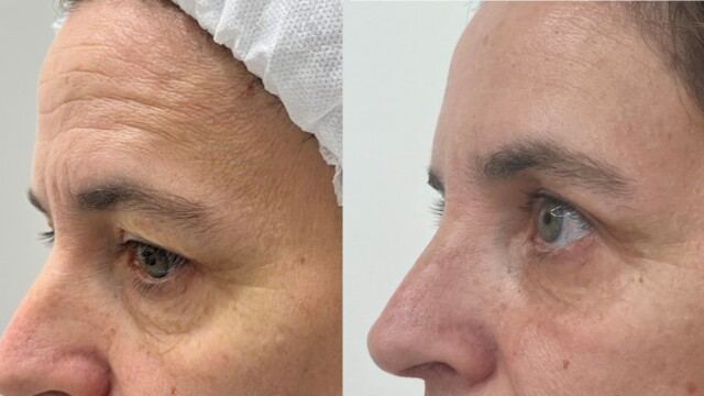 Blépharoplastie-paupières-chirurgie au laser