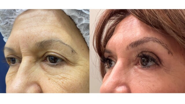 Blépharoplastie-paupières-chirurgie au laser