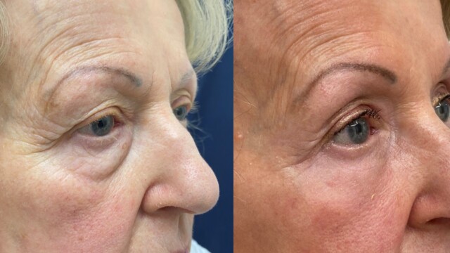 Blépharoplastie-paupières-chirurgie au laser