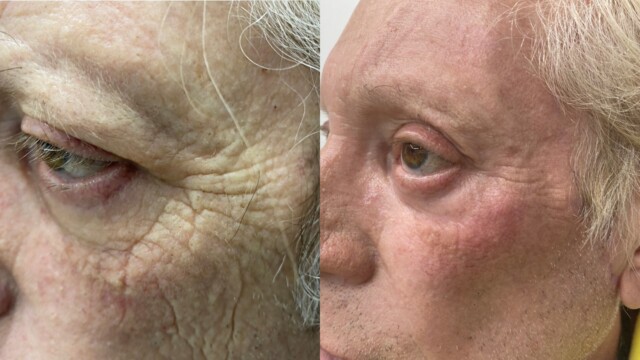 Blépharoplastie-paupières-chirurgie au laser