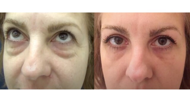 Blépharoplastie-paupières-chirurgie au laser