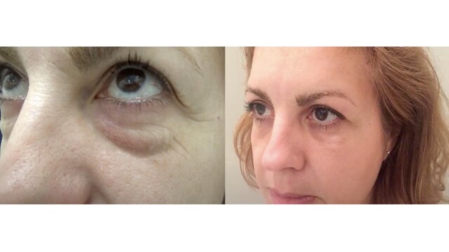 Blépharoplastie-paupières-chirurgie au laser