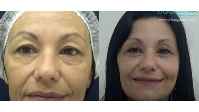 Blépharoplastie-paupières-chirurgie au laser