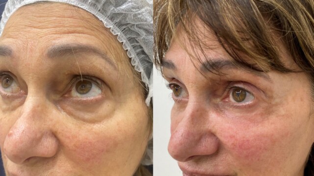 Blépharoplastie-paupières-chirurgie au laser