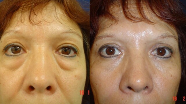 Blépharoplastie-paupières-chirurgie au laser