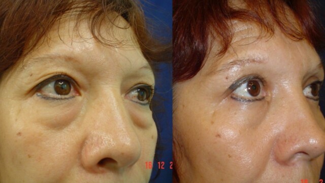 Blépharoplastie-paupières-chirurgie au laser