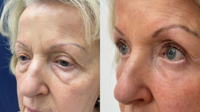 Blépharoplastie-paupières-chirurgie au laser
