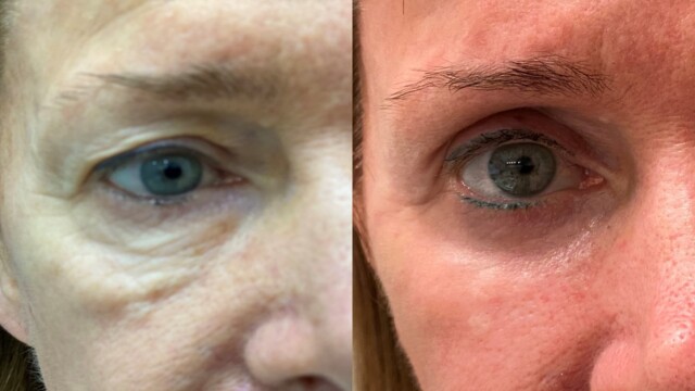 Blépharoplastie-paupières-chirurgie au laser