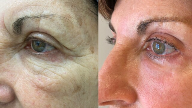 Blépharoplastie-paupières-chirurgie au laser
