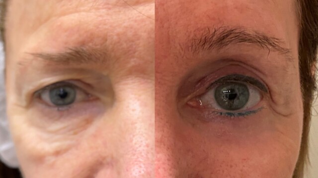 Blépharoplastie-paupières-chirurgie au laser