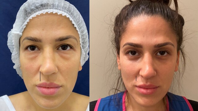 Blépharoplastie-paupières-chirurgie au laser