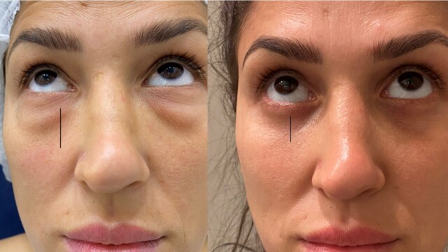 Blépharoplastie-paupières-chirurgie au laser