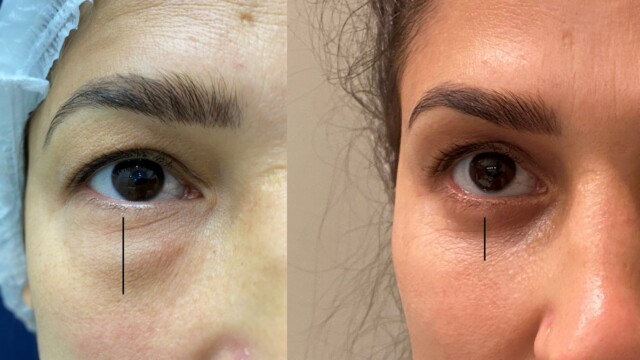 Blépharoplastie-paupières-chirurgie au laser